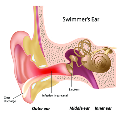 Swimmer's ear