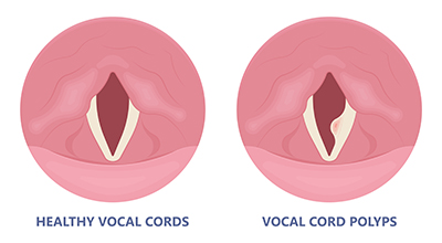 Vocal cord polyp
