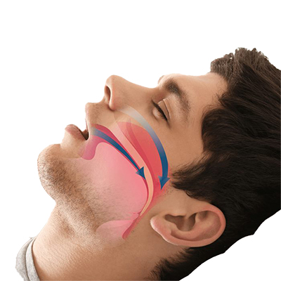 OSAS (obstructive sleep apnea)