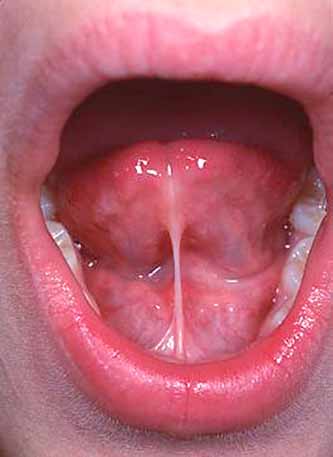 Ankyloglossia (Tongue-tie)