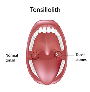Tonsil stones (Tonsilolith)